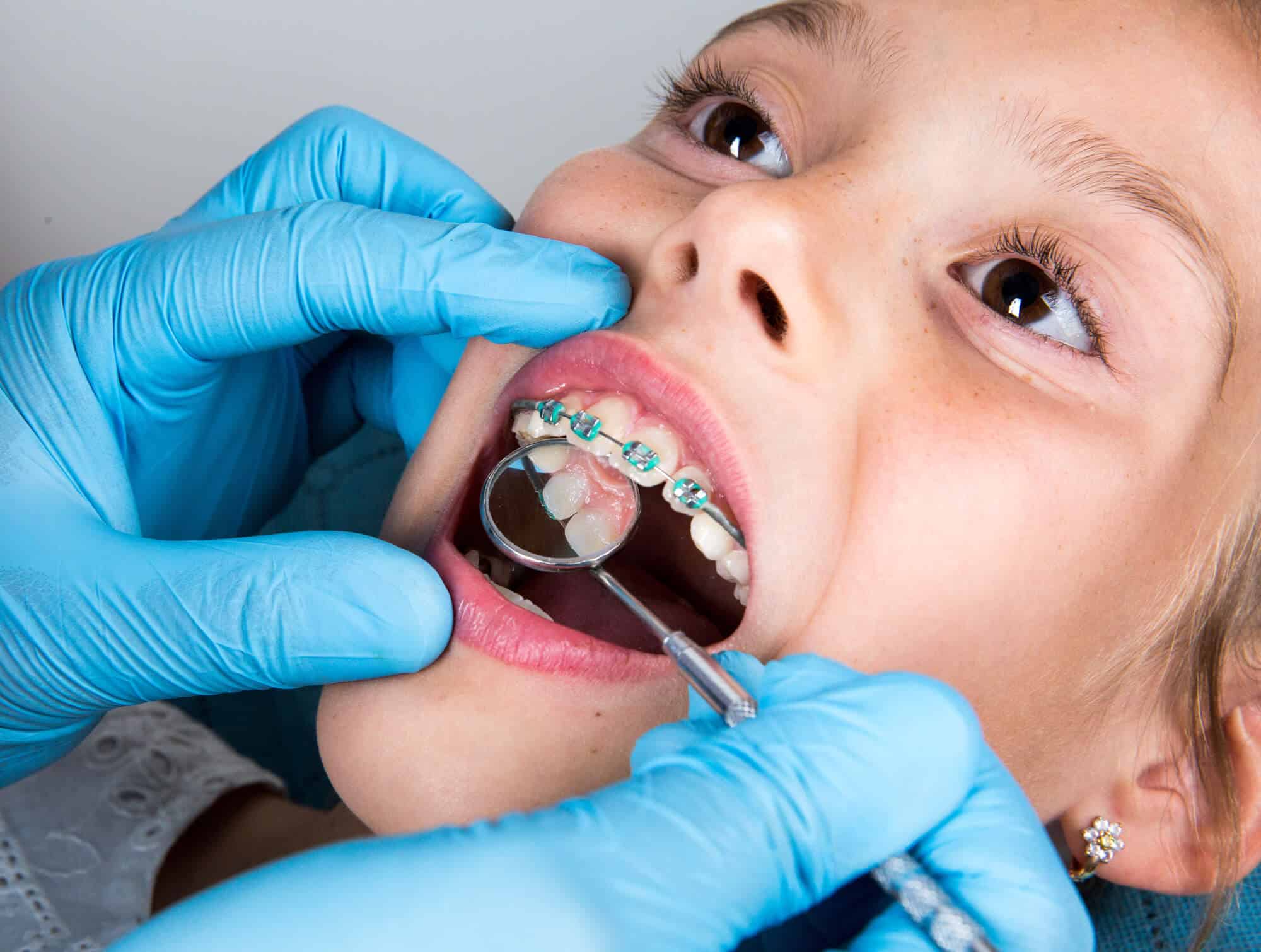 The Role of the Palatal Expander in Pediatric Orthodontistry - Sencak  Orthodontics