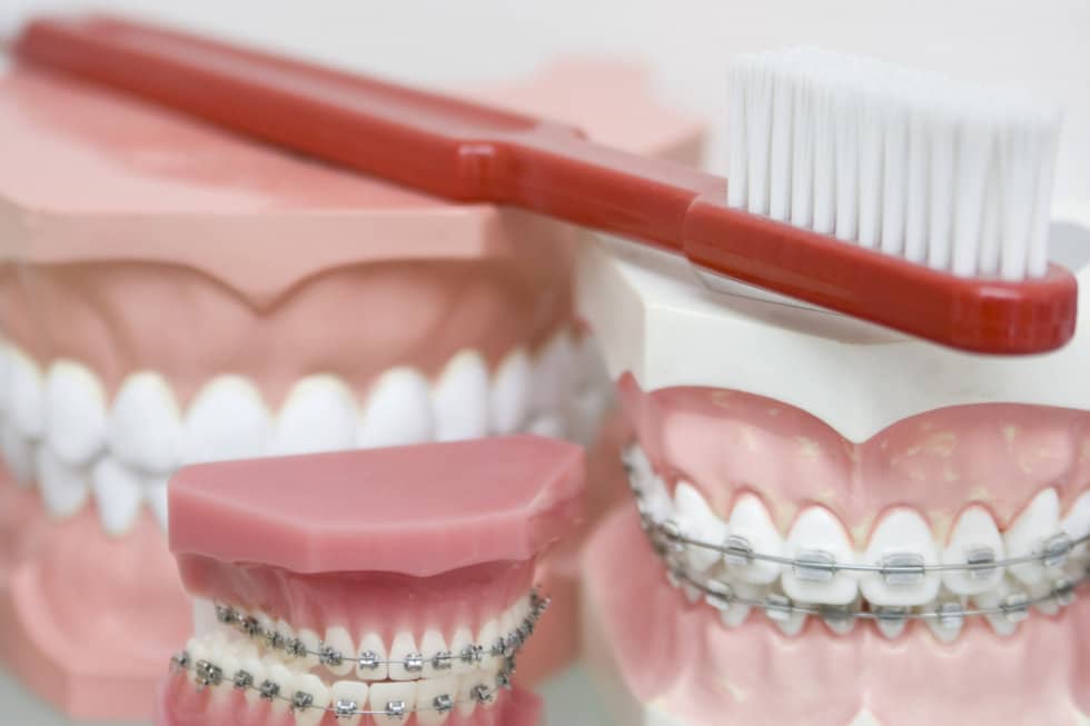 How Much Is the Average Cost of Braces? Sencak Orthodontics