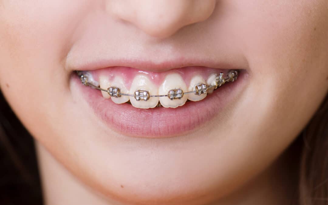 Is It Possible to Straighten Teeth Quickly? Here’s What Your Orthodontist Would Say