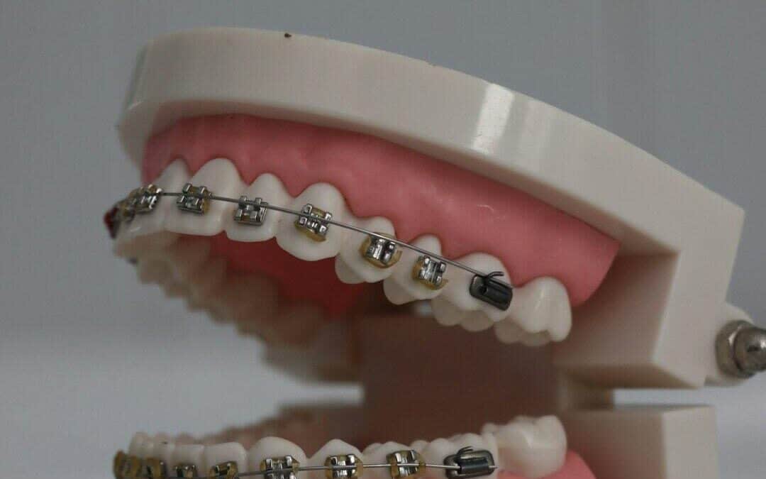 traditional braces for adults